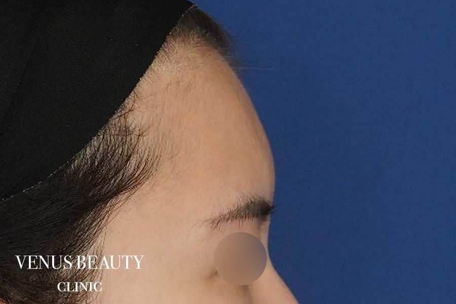 脂肪注入 施術前