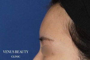 脂肪注入 施術前