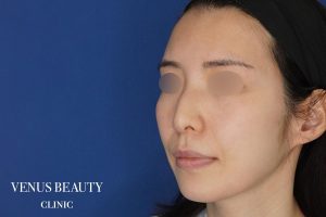脂肪注入 施術前