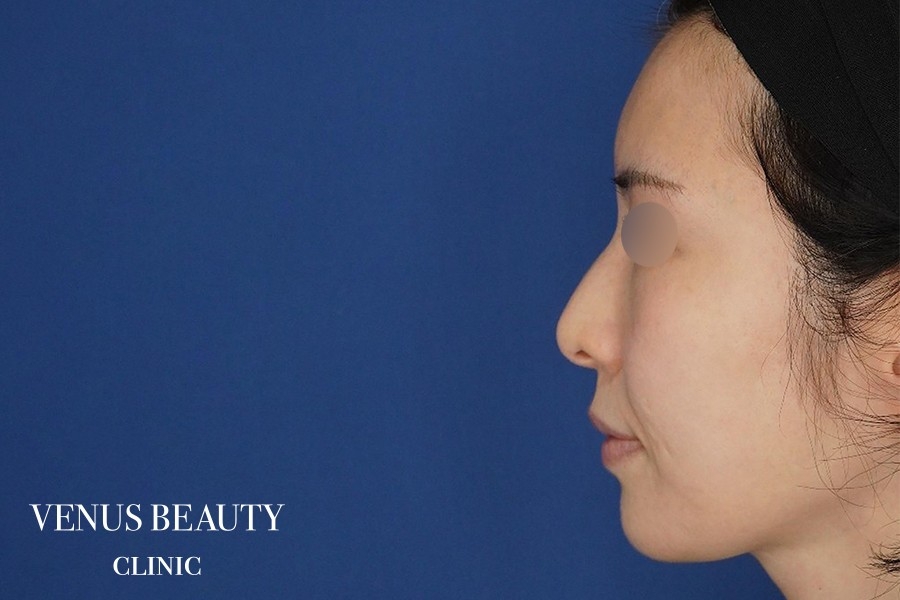 脂肪注入 施術前