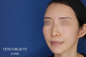 脂肪注入 施術後