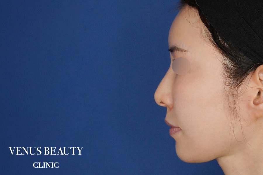 脂肪注入 施術後