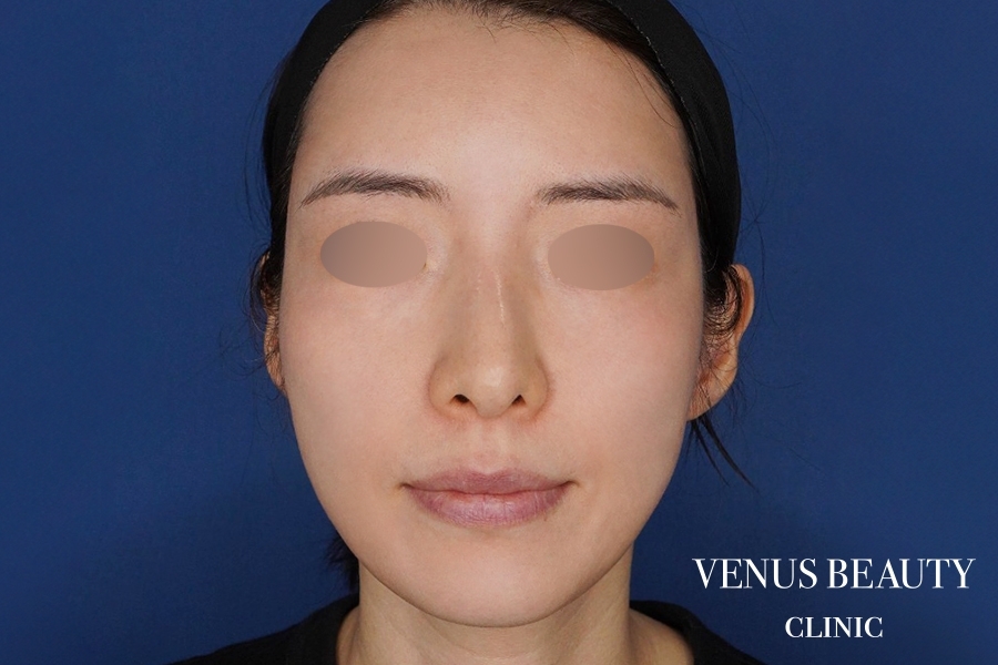 脂肪注入 施術後