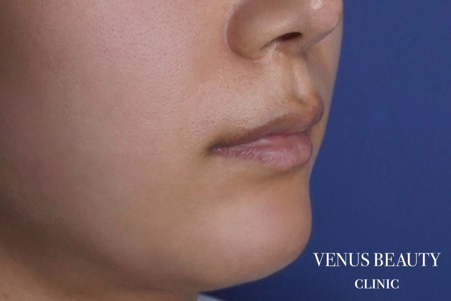 人中短縮術 施術前