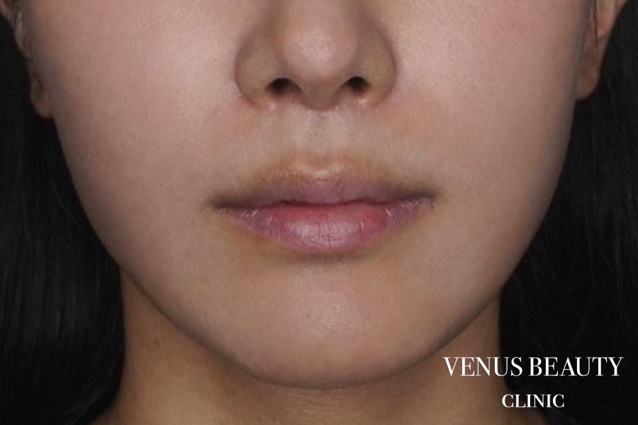 人中短縮術 施術後