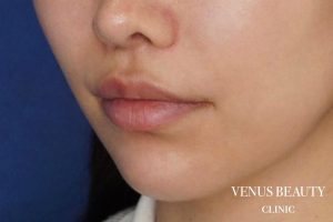 人中短縮術 施術後