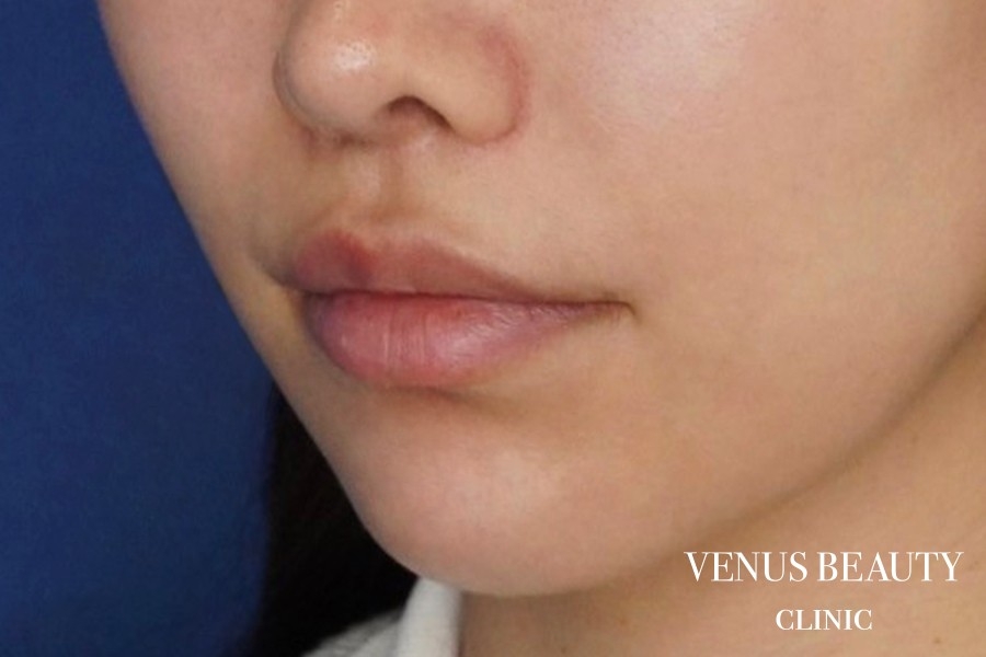 人中短縮術 施術後