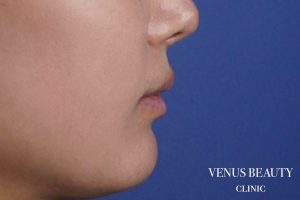 人中短縮術 施術後