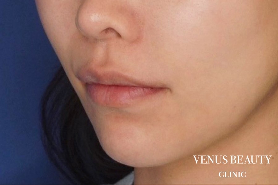 人中短縮術 施術前