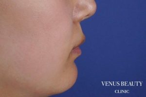 人中短縮術 施術前