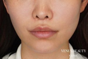 人中短縮術 施術後