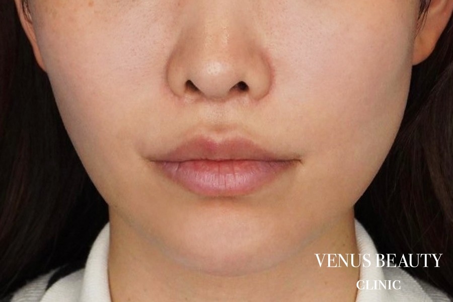 人中短縮術 施術後