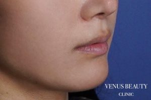 人中短縮術 施術後