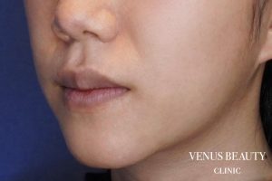 M字リップ形成 施術前