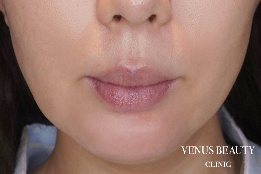 人中短縮術 施術前