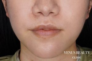 M字リップ形成 施術後
