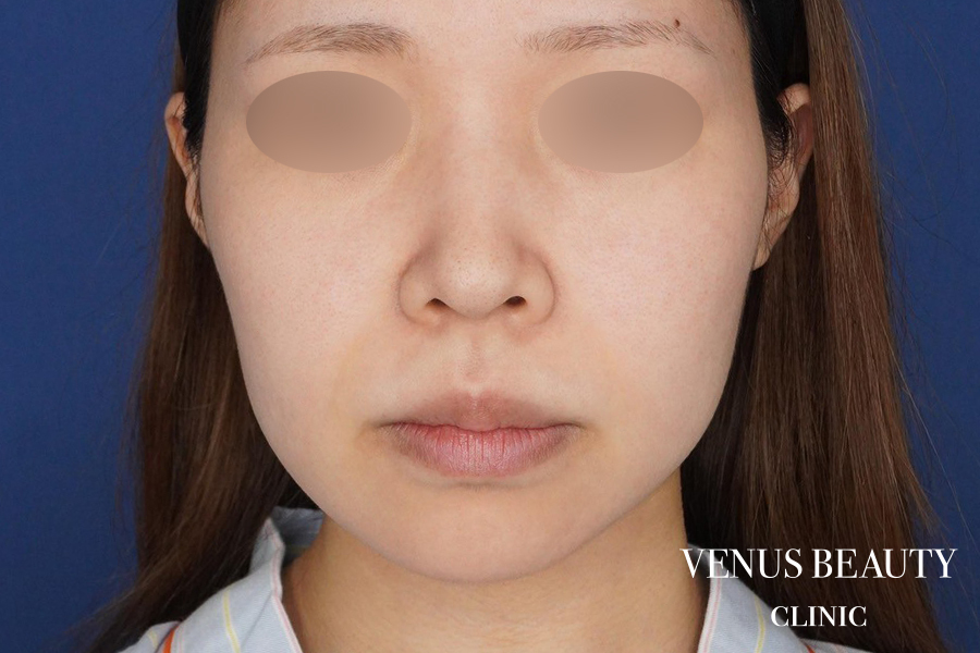 糸リフト＋脂肪吸引 施術前