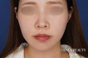 糸リフト+脂肪吸引 施術後