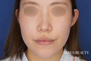 糸リフト+脂肪吸引 施術前