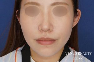 糸リフト+脂肪吸引 施術後