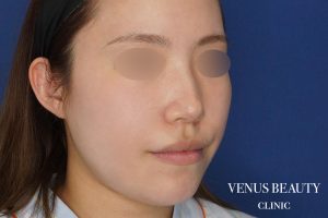 糸リフト+脂肪吸引 施術前