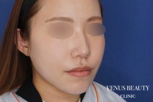 糸リフト+脂肪吸引 施術後