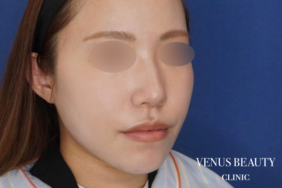 糸リフト＋脂肪吸引 施術後