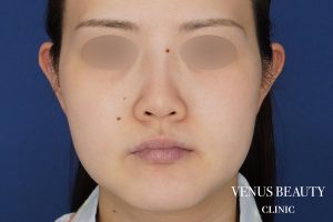 糸リフト+脂肪吸引 施術前