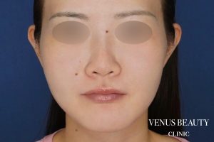 糸リフト+脂肪吸引 施術後