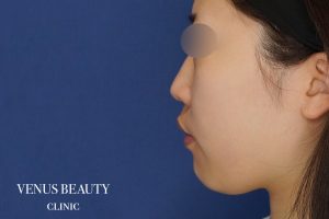 糸リフト+脂肪吸引 施術前