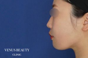 糸リフト+脂肪吸引 施術後