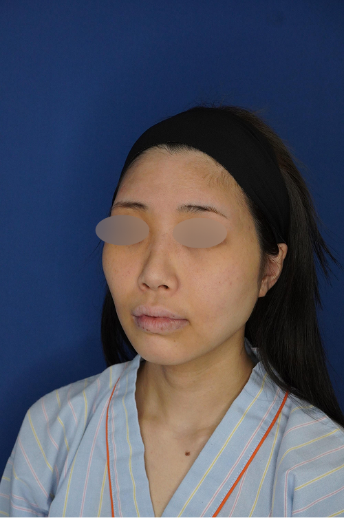 耳介軟骨移植 施術前