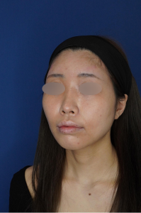 耳介軟骨移植 施術後