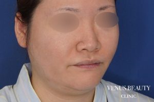 糸リフト+脂肪吸引 施術前