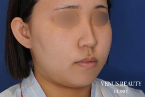 糸リフト+脂肪吸引 施術前