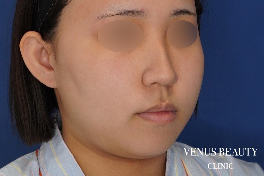 糸リフト＋脂肪吸引 施術前