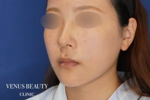 糸リフト+脂肪吸引 施術後