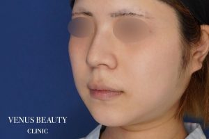 糸リフト+脂肪吸引 施術前