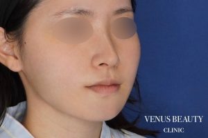 糸リフト+脂肪吸引 施術後