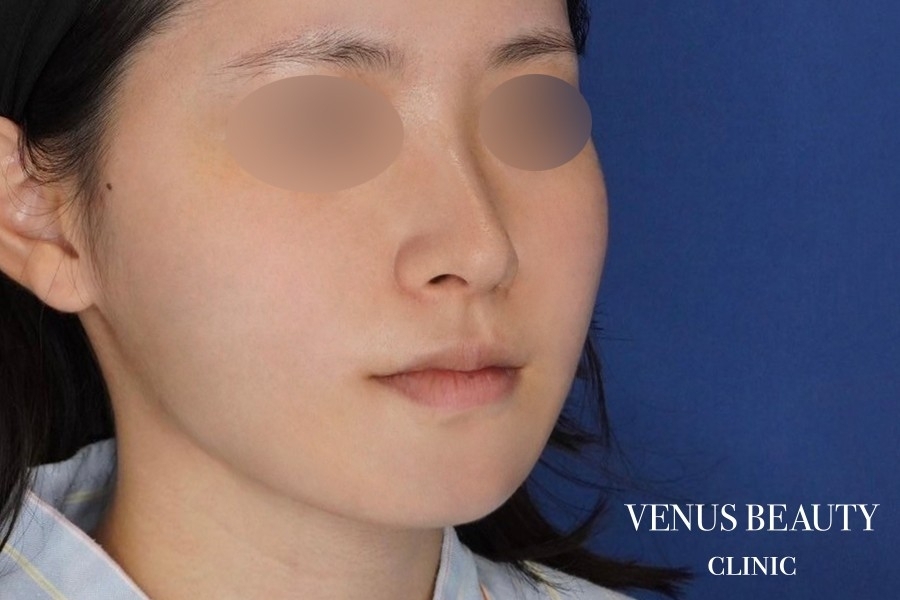 糸リフト＋脂肪吸引 施術後