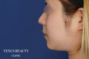 糸リフト+脂肪吸引 施術前