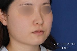 糸リフト+脂肪吸引 施術前