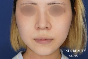 糸リフト+脂肪吸引 施術前