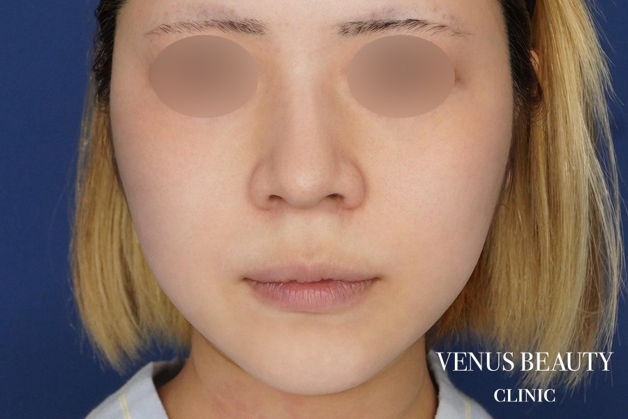 糸リフト＋脂肪吸引 施術前