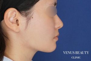 糸リフト+脂肪吸引 施術後