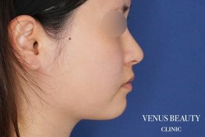 糸リフト+脂肪吸引 施術前