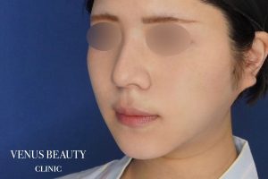 糸リフト+脂肪吸引 施術後