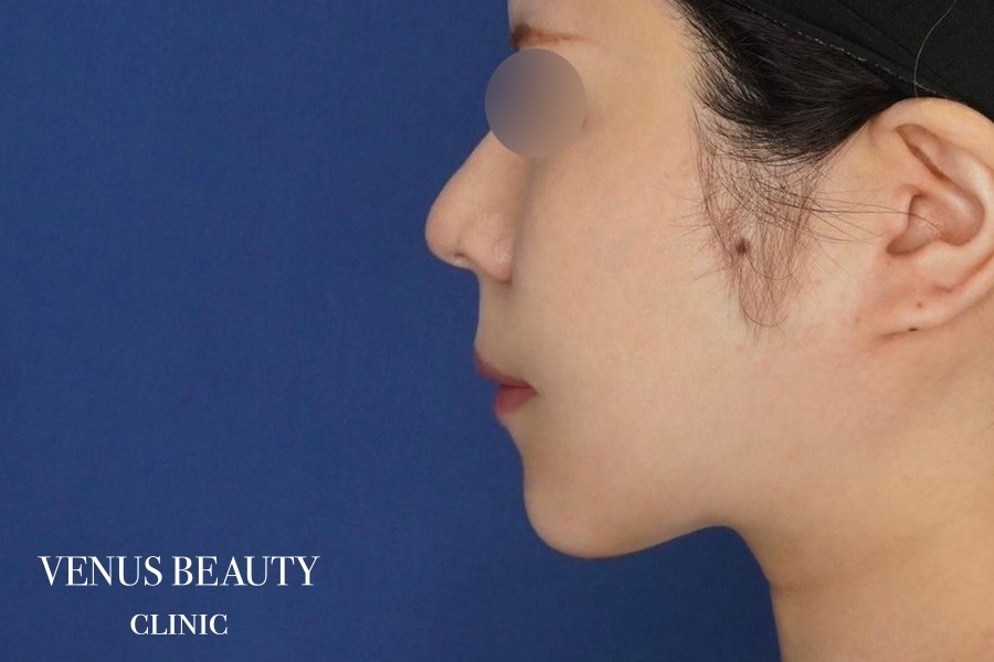 糸リフト＋脂肪吸引 施術後