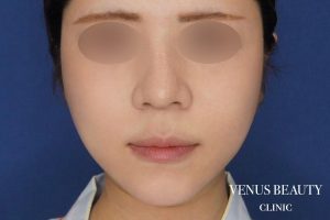 糸リフト+脂肪吸引 施術後