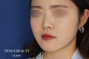 糸リフト+脂肪吸引 施術後